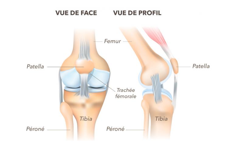 L'arthrose de genou ou gonarthrose