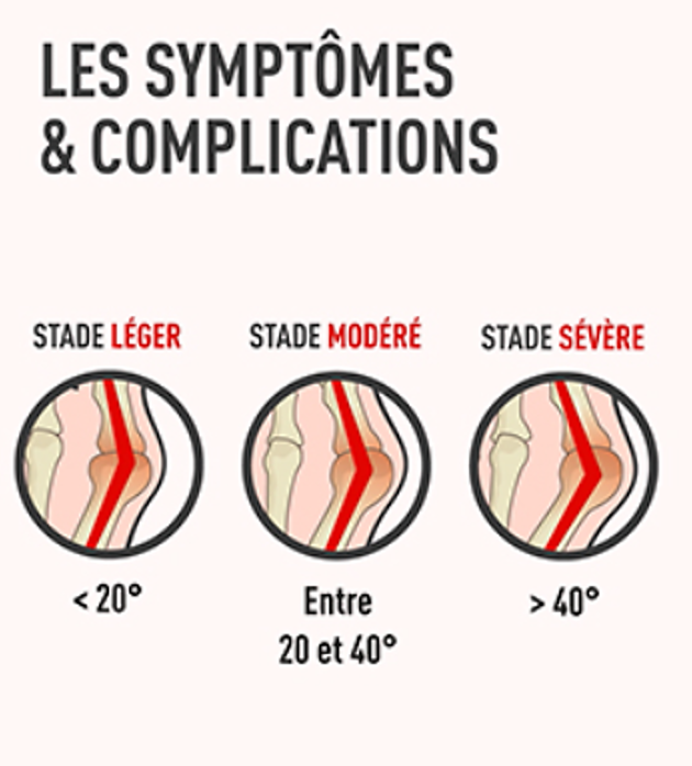 Hallux valgus ; étape